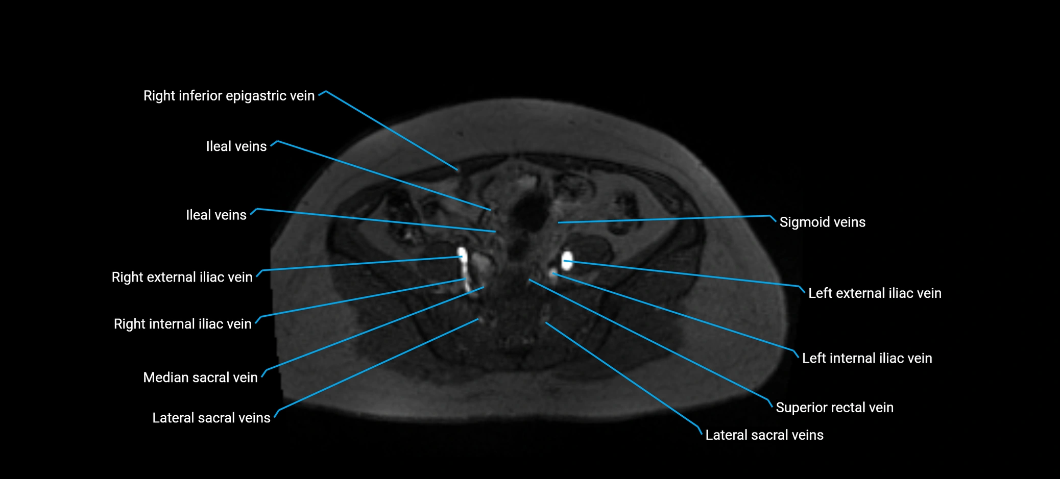 MRV abdomen pelvis & lower limb axial cross sectional anatomy labelled MRI image 136 (1).webp